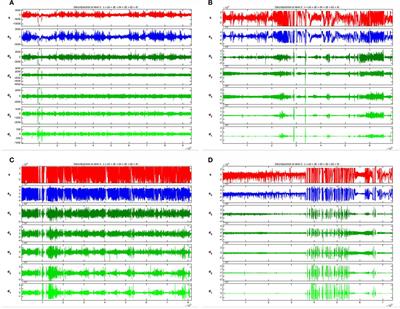 Dynamic Changes in Spectral and Spatial Signatures of High Frequency Oscillations in Rat Hippocampi during Epileptogenesis in Acute and Chronic Stages